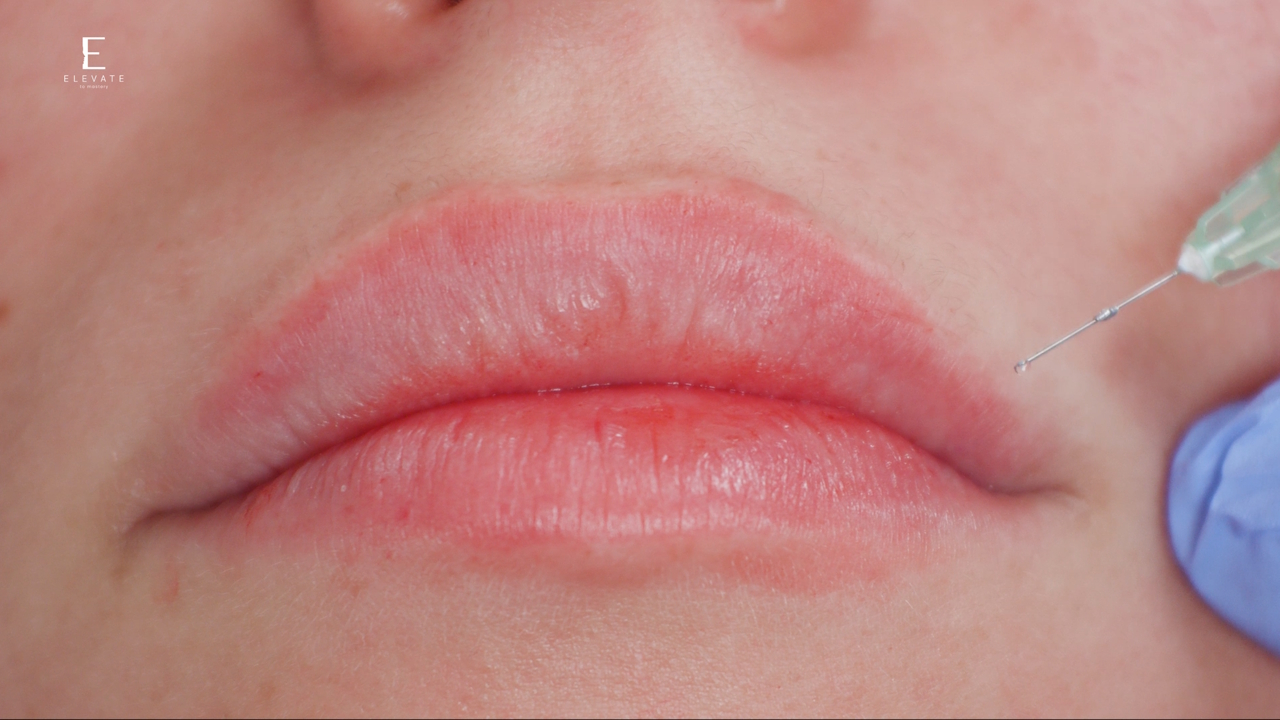 Balancing Lip Proportions In Younger Patients