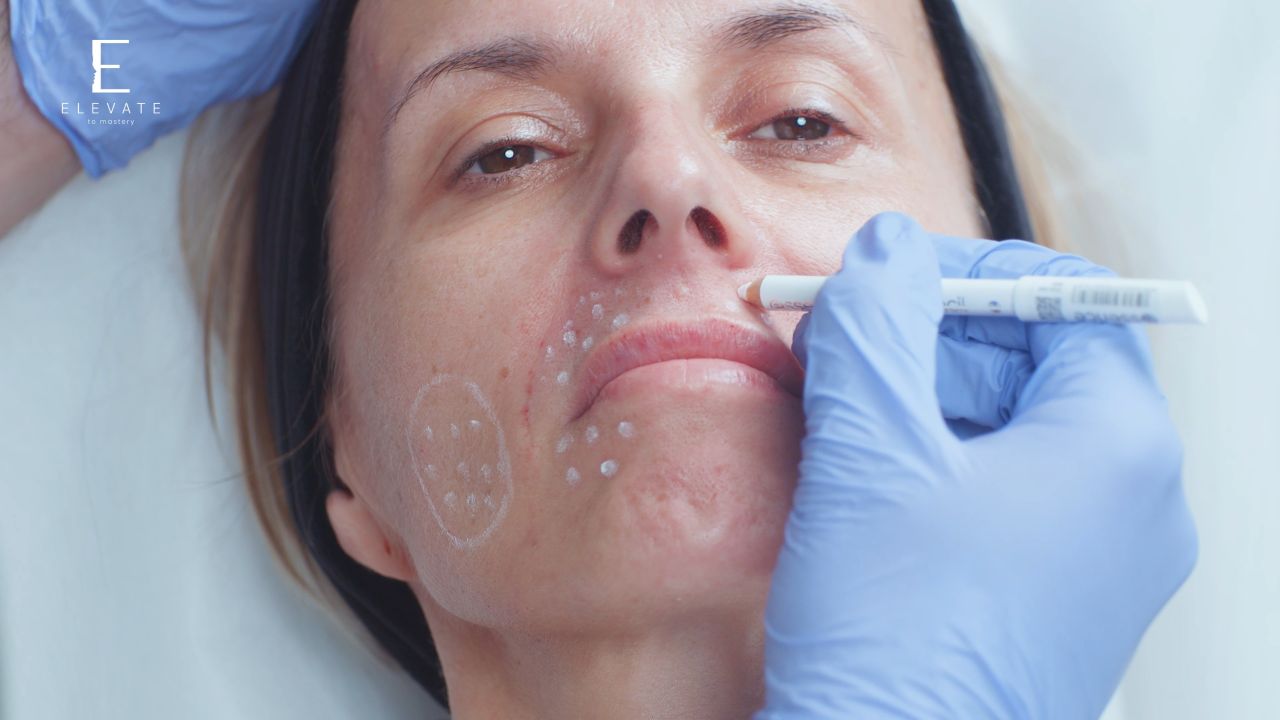 Enhancing Skin Quality Perioral & Submalar Skin Booster Treatment