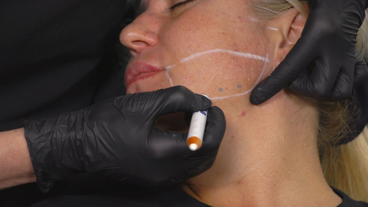 Full Face Botulinum Toxin Treatment