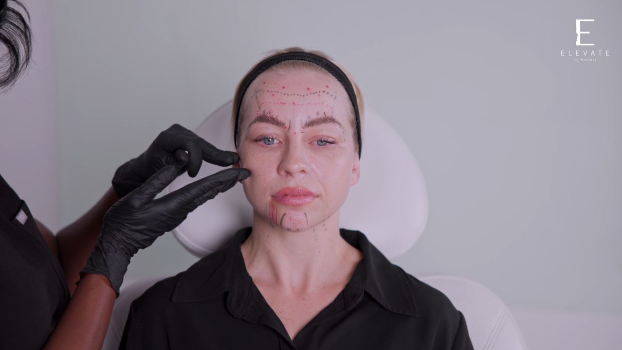 From Assessment To Injection Strategy Mapping The Full Face Treatment Plan