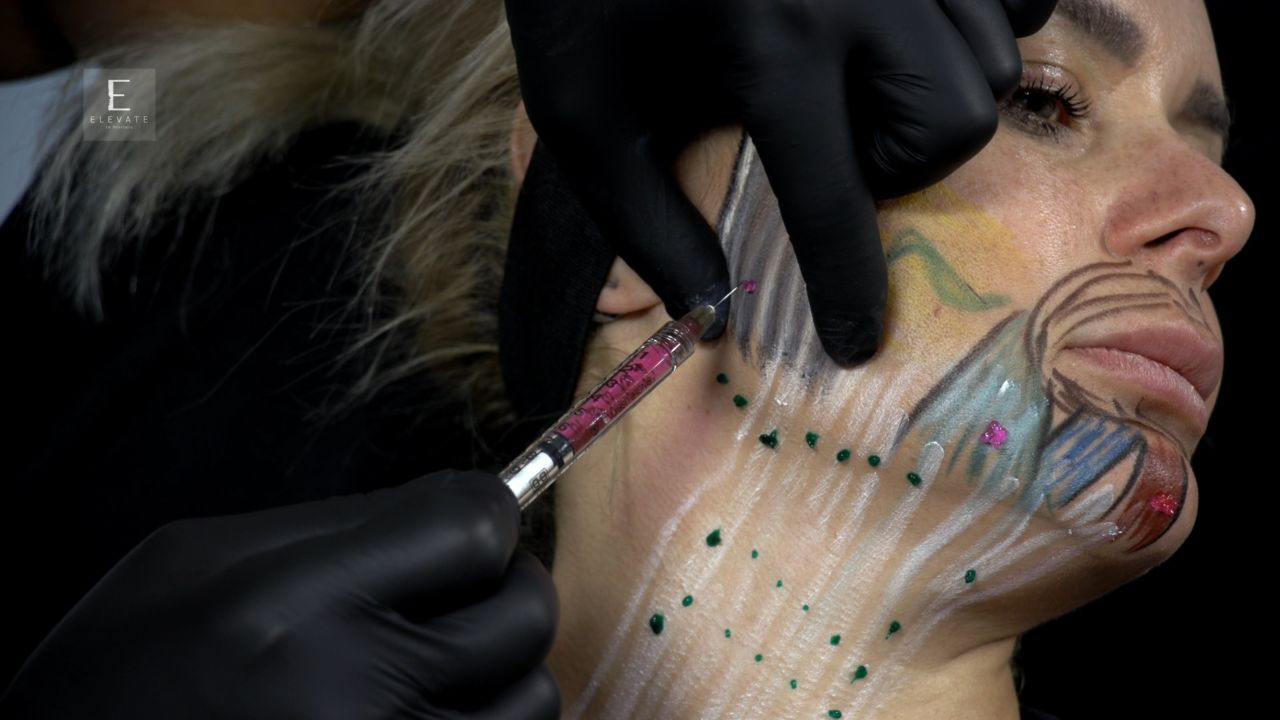 Lower Face & Neck Region For Neurotoxin