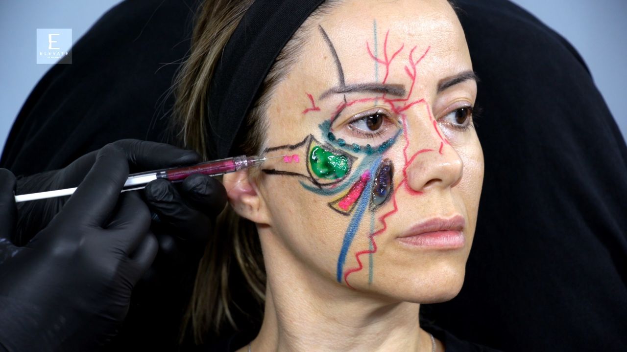Thumbnail Applied Anatomy Midface & Periorbital Region For Ha Fillers
